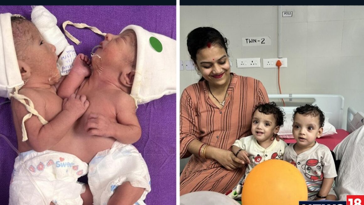 एम्स में आपस में जुड़ी दो बच्चियों को किया गया अलग, दोनों बच्चे स्वस्थ